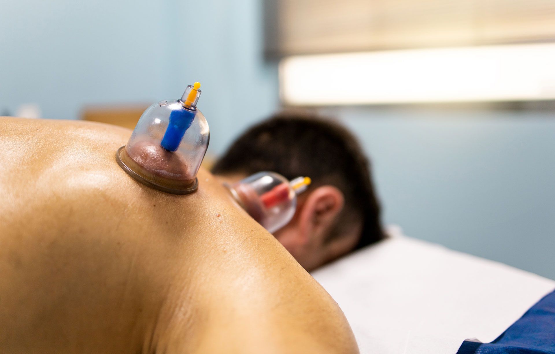 A person lying face down with cupping therapy suction cups applied to their upper back and shoulder area.