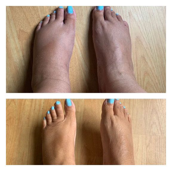 A side-by-side comparison of feet showing swelling (top) and reduced swelling (bottom).
