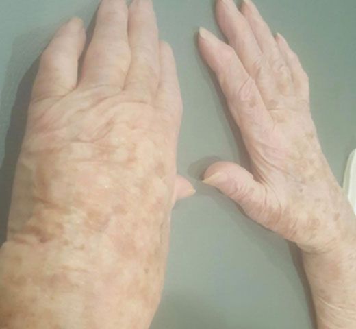 A close-up view of two hands showing age-related skin spots and texture against a neutral background.