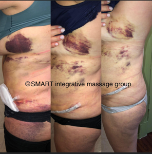 Three side-by-side photos showing a torso with post-surgical bruising, incision sites, and bandages.