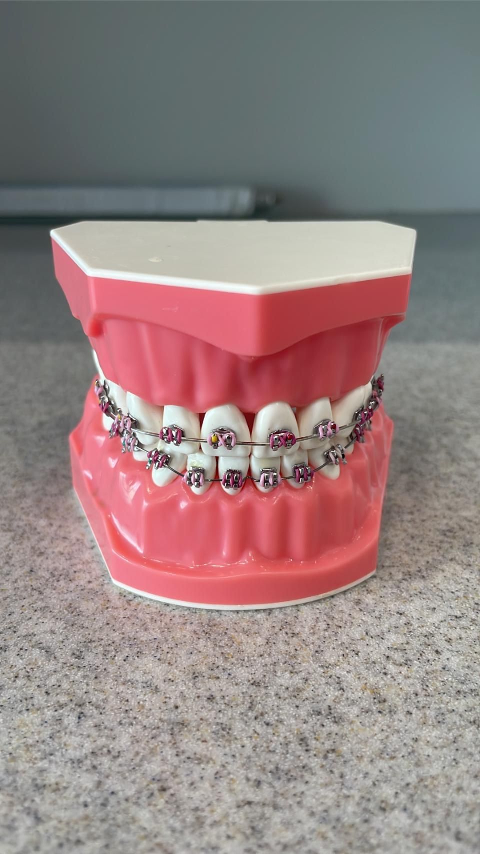 A model of a person 's teeth with braces on them