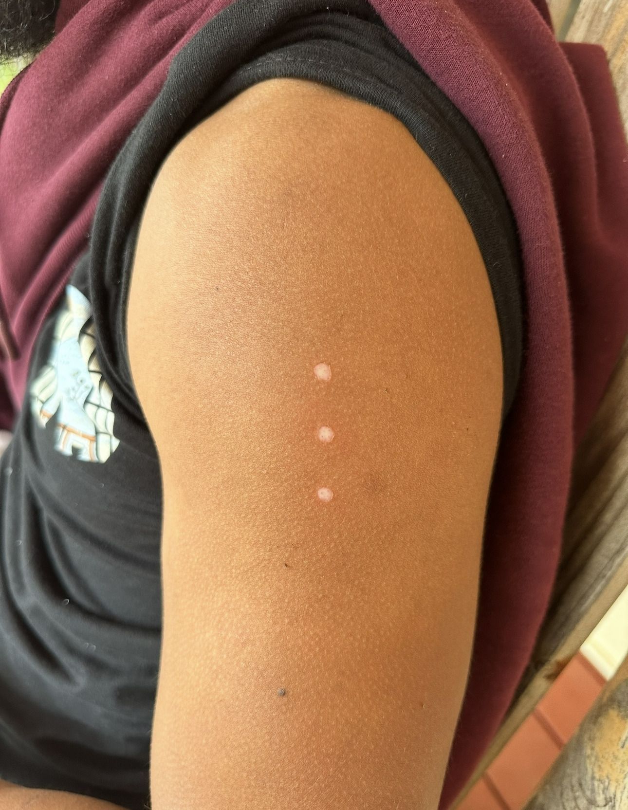 Three small, raised, white bumps in a vertical line on a person's upper arm.