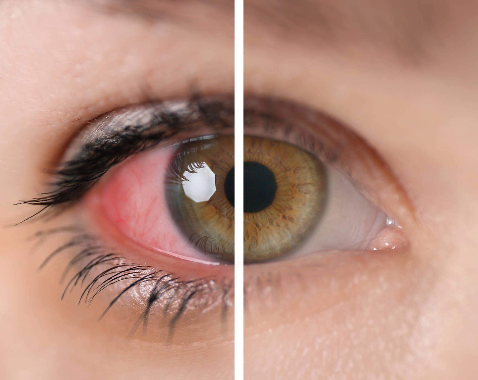 רופא עיניים מומחה ליובש בעיניים