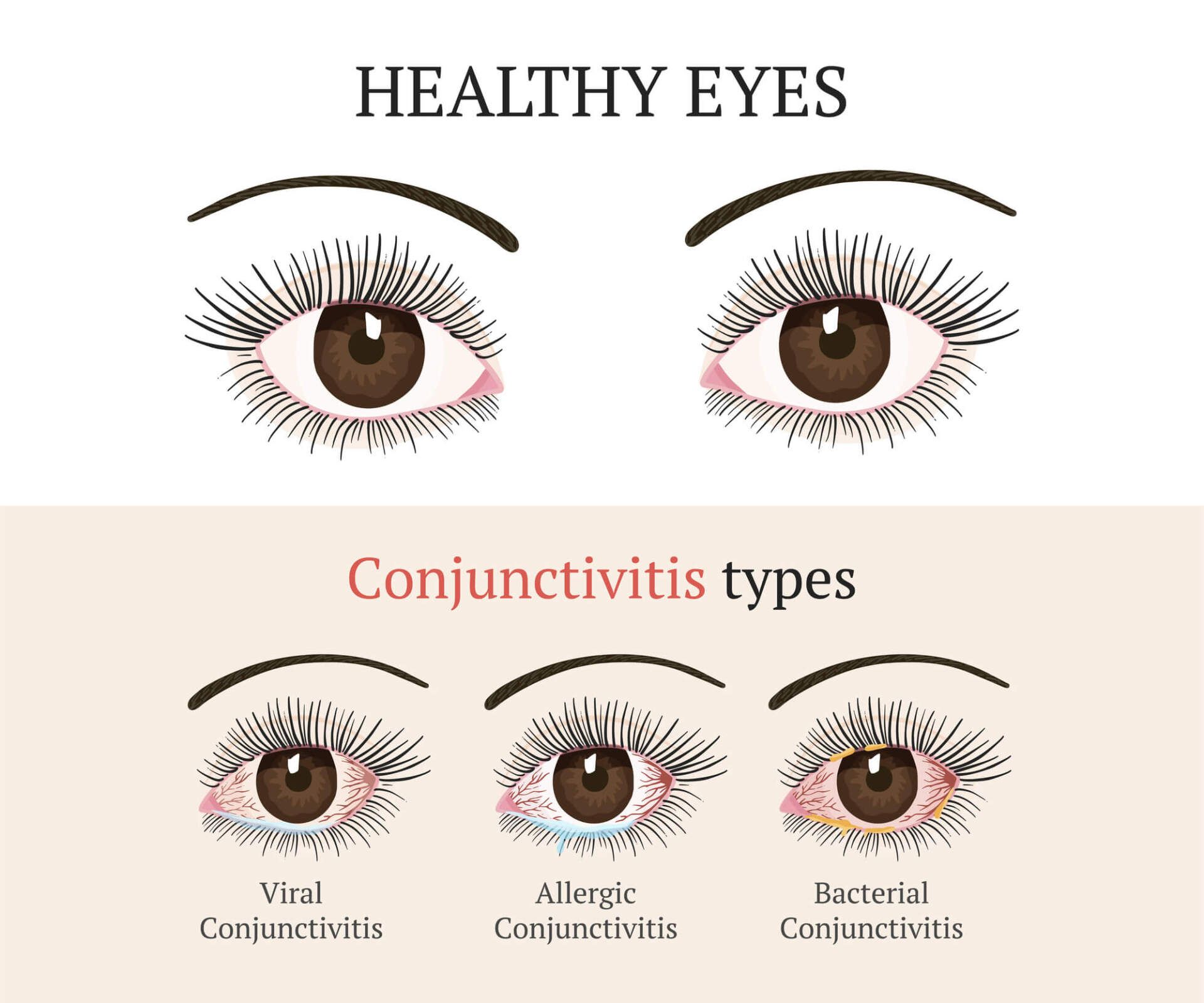 סוגי דלקות עיניים