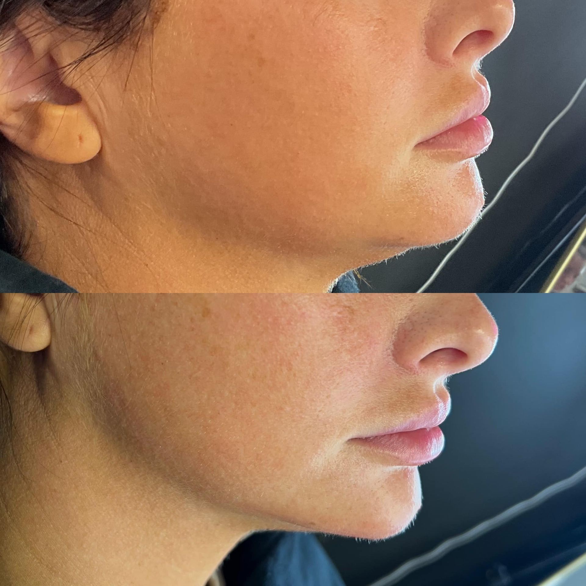 before and after neck injections springfield mo