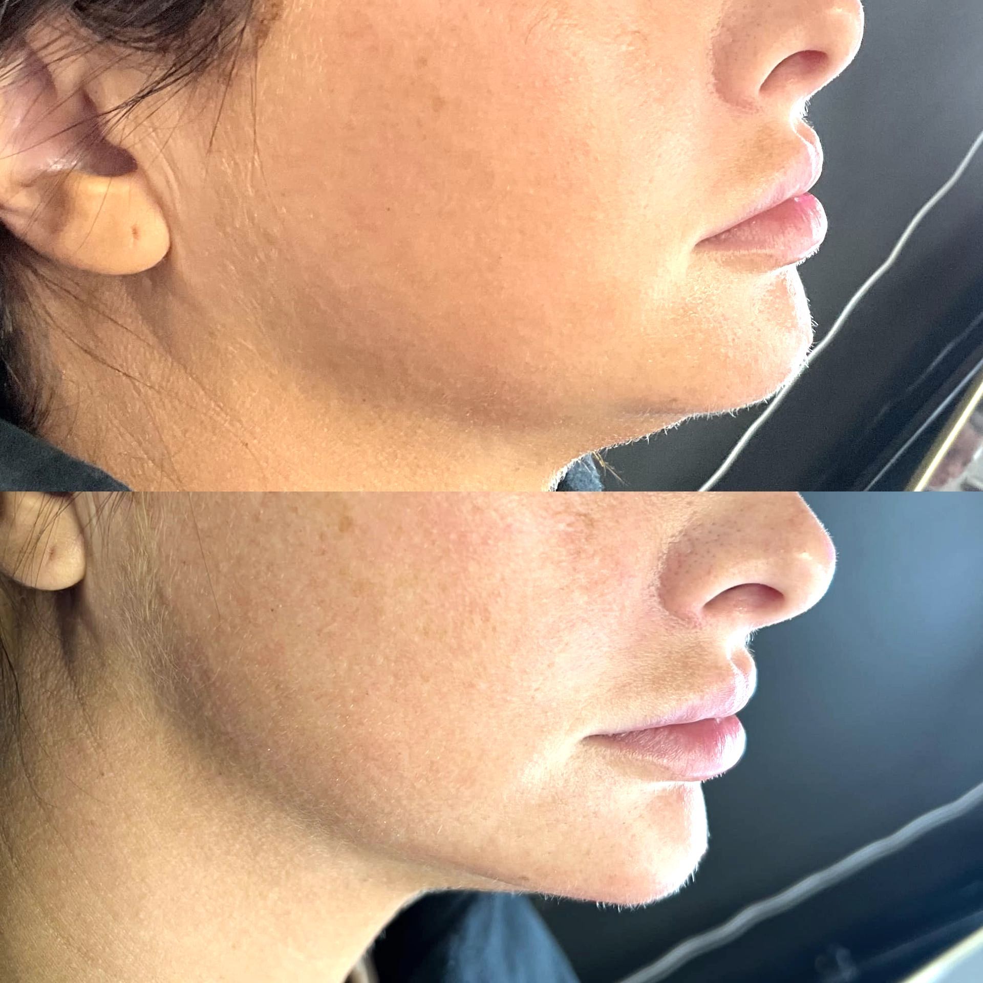 fat dissolving before and after | Kybella springfield mo
