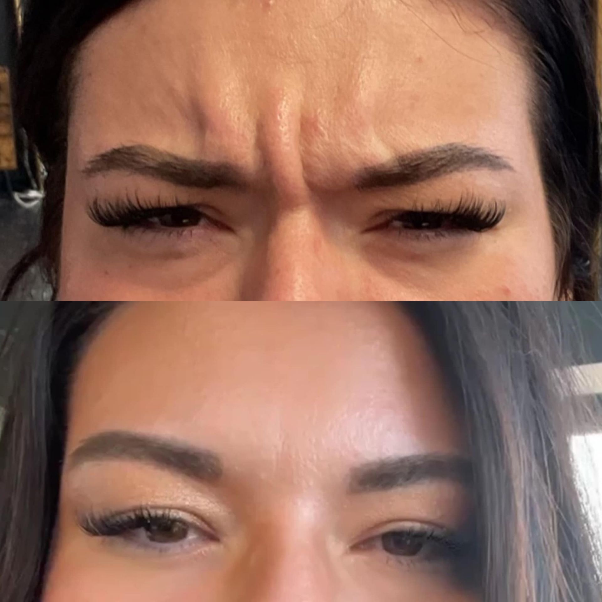 before and after forehead botox springfield mo