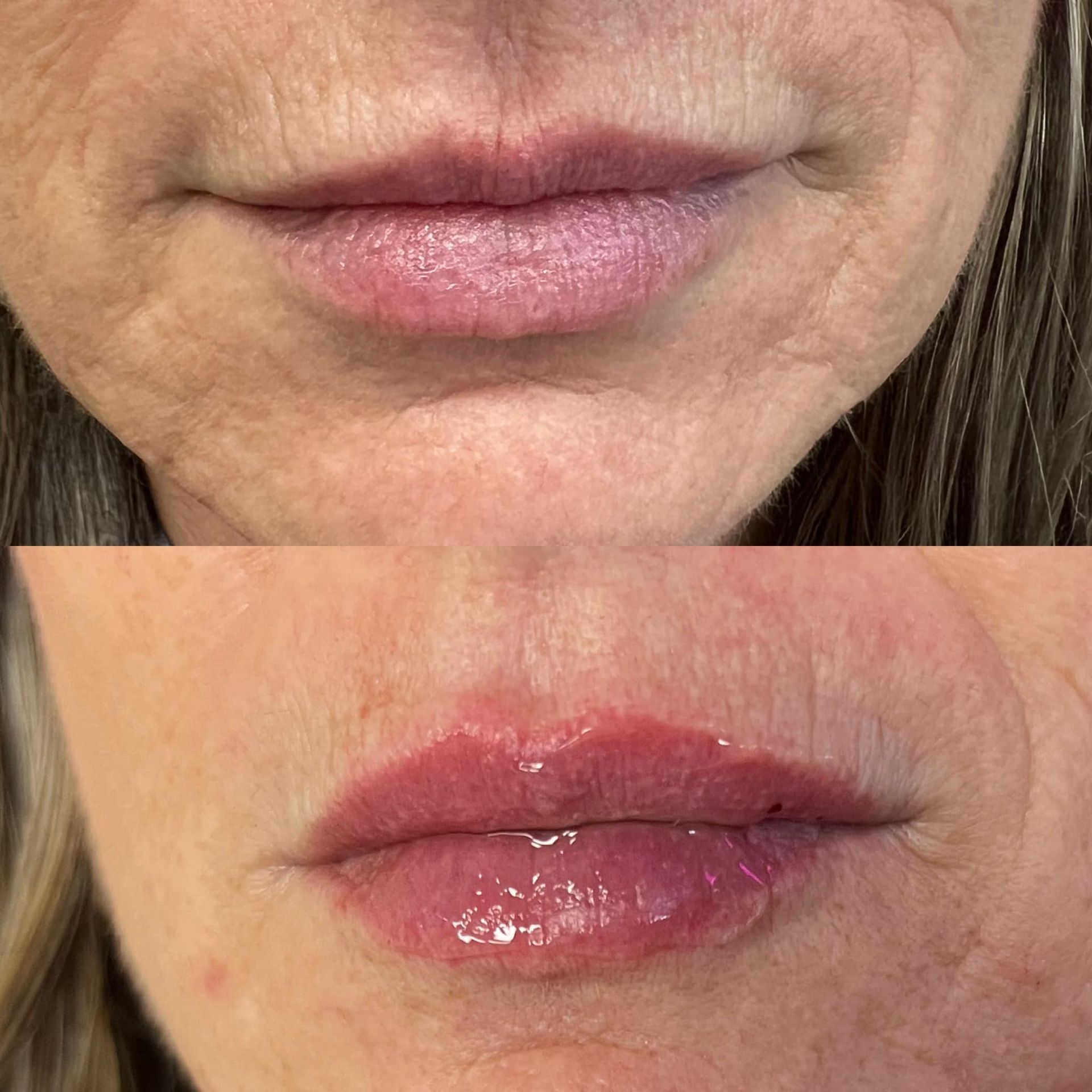 before and after lip fillers | Springfield MO