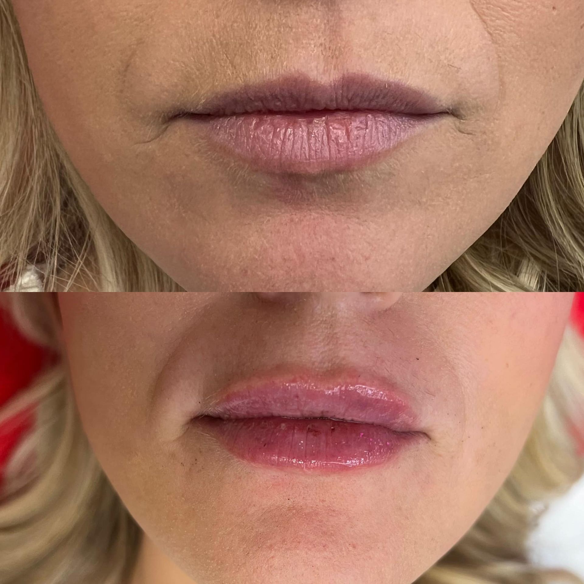before and after lip fillers at our Springfield MO salon