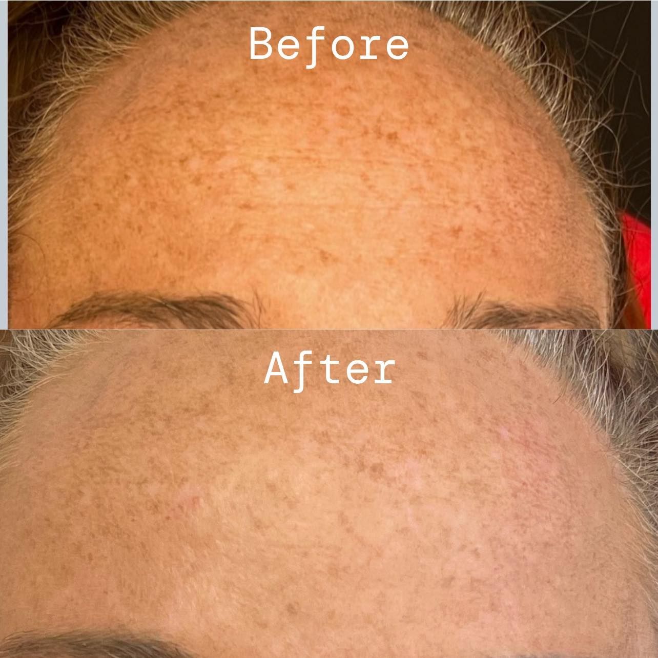 before and after botox forehead springfield mo