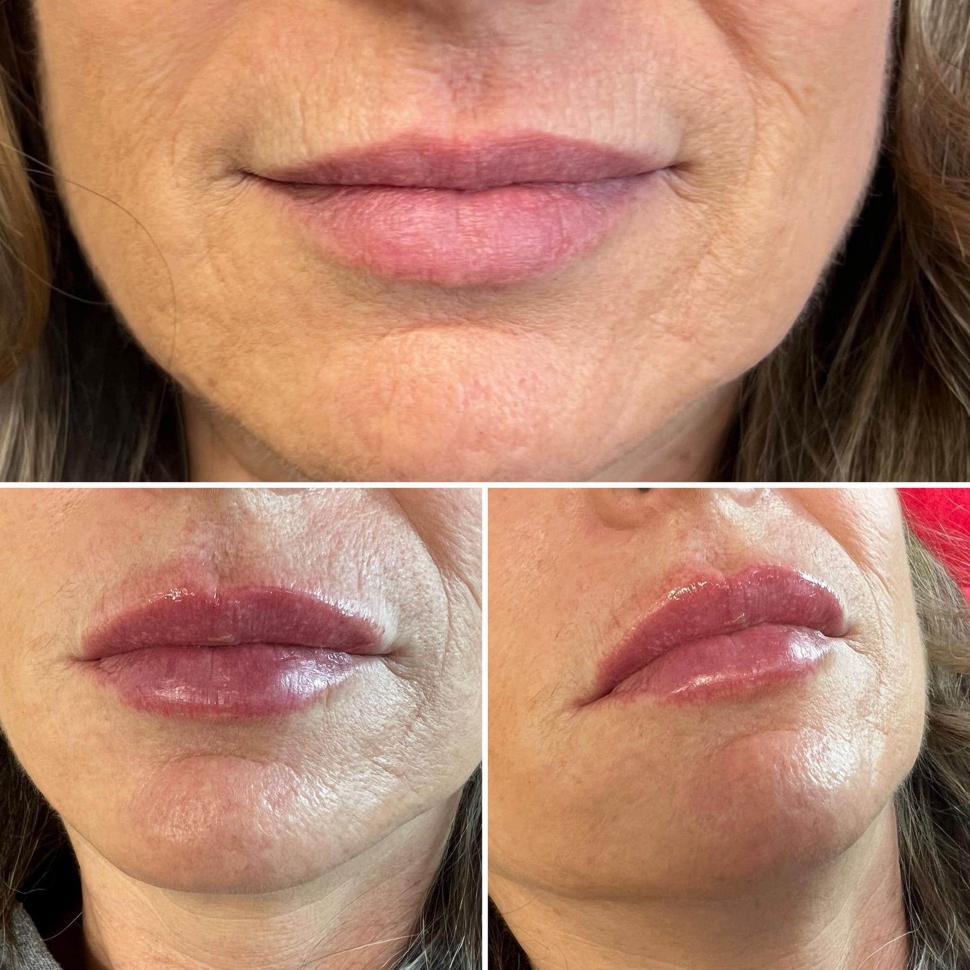 before and after lip fillers | Springfield mo