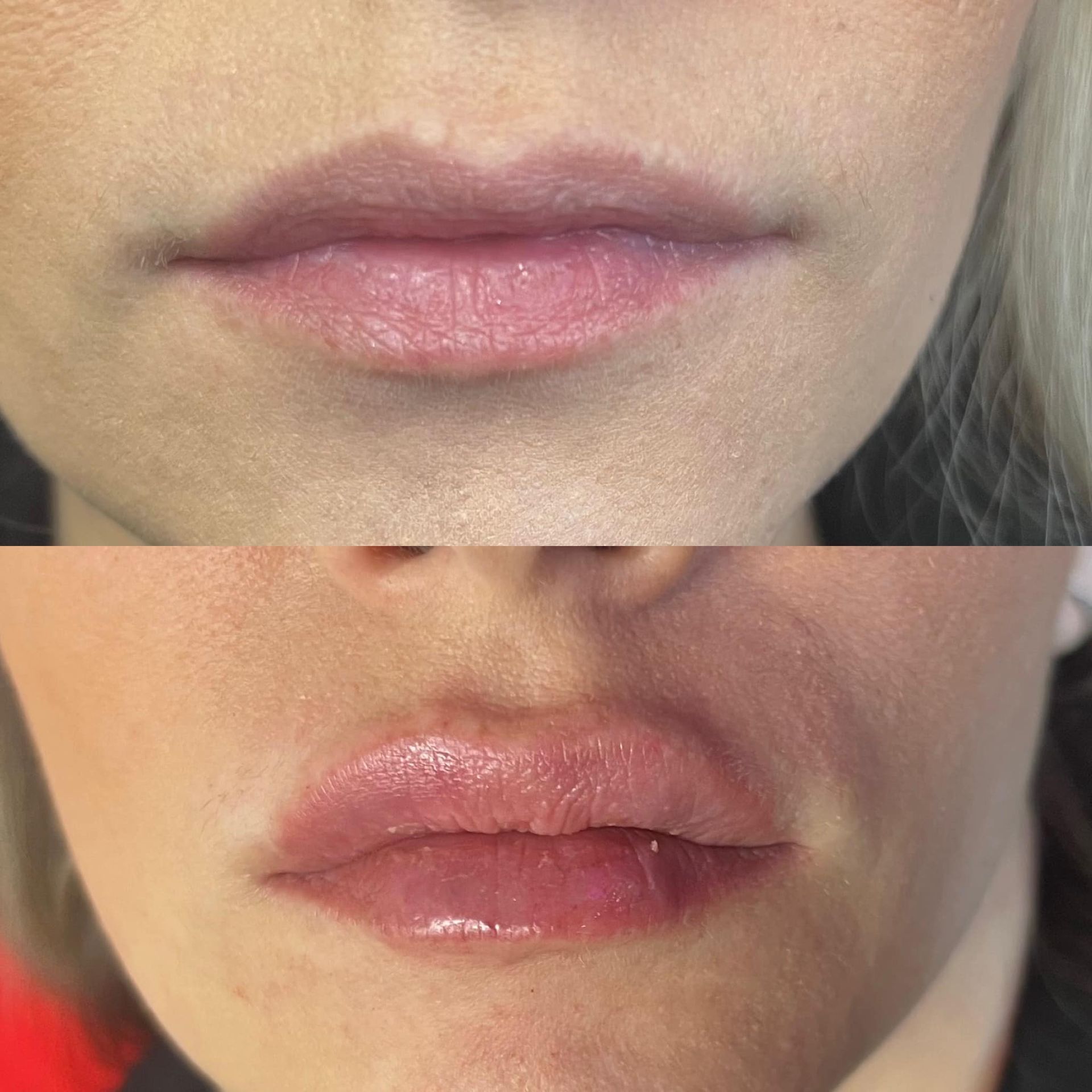best lip filler treatments springfield mo