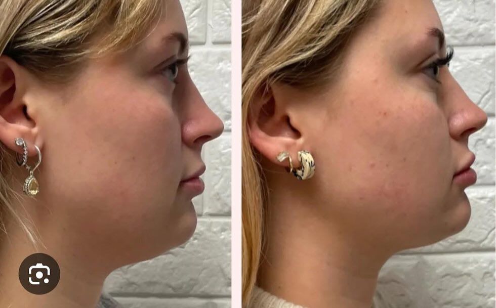 before and after fat dissolving | kybella springfield mo