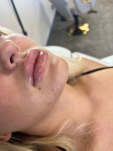 lip filler in springfield mo
