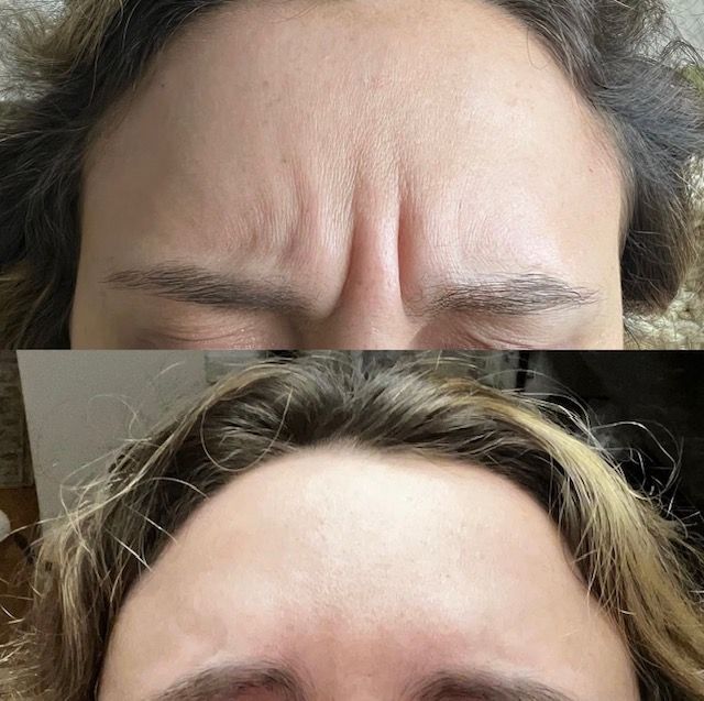before and after botox on forehead in springfield mo