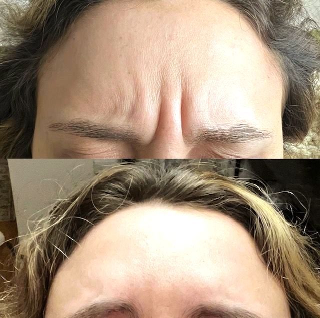 before and after squinting botox springfield mo