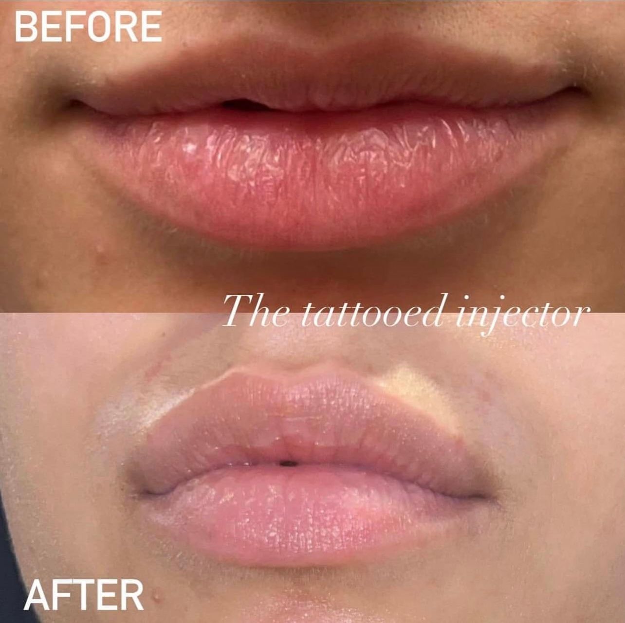 before and after lip flip in springfield mo