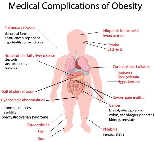 Medical Complications of Obesity