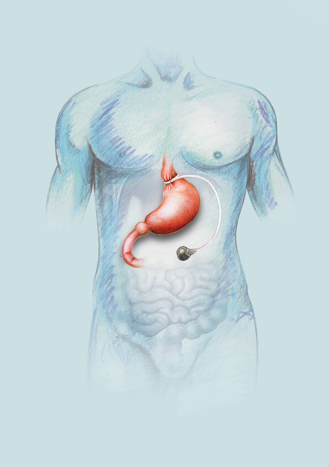 Gastric Band Bariatric Surgery