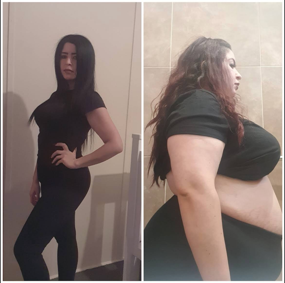 Patient Darren Before and After weight loss