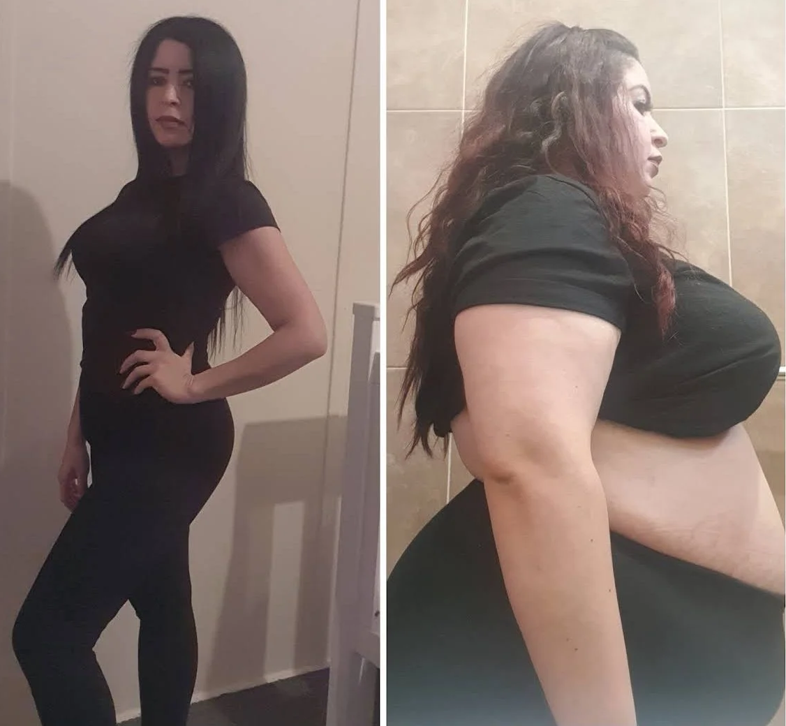 Dramatic Weight Loss  Surgery Liverpool, NSW 