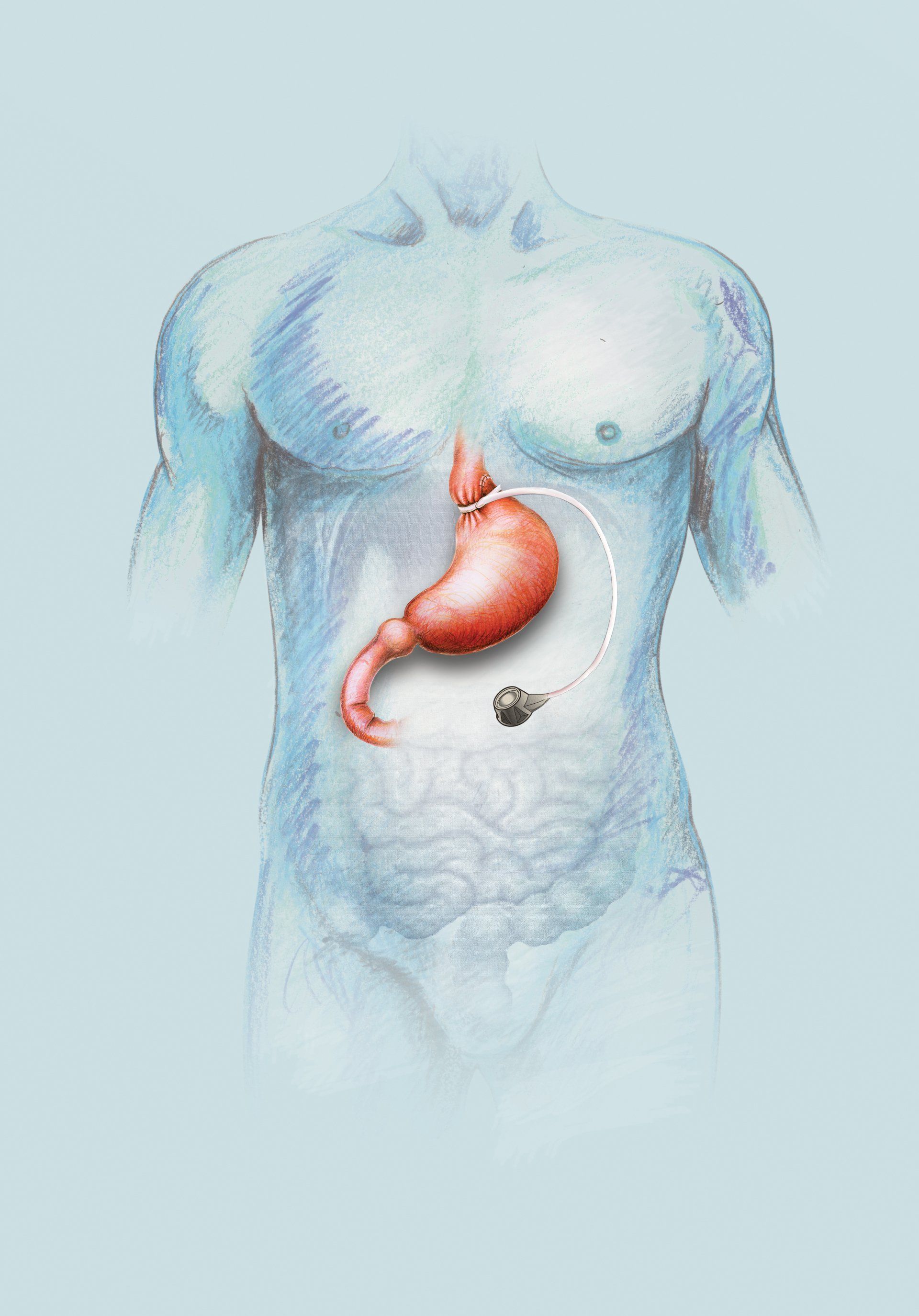 Gastric Band image