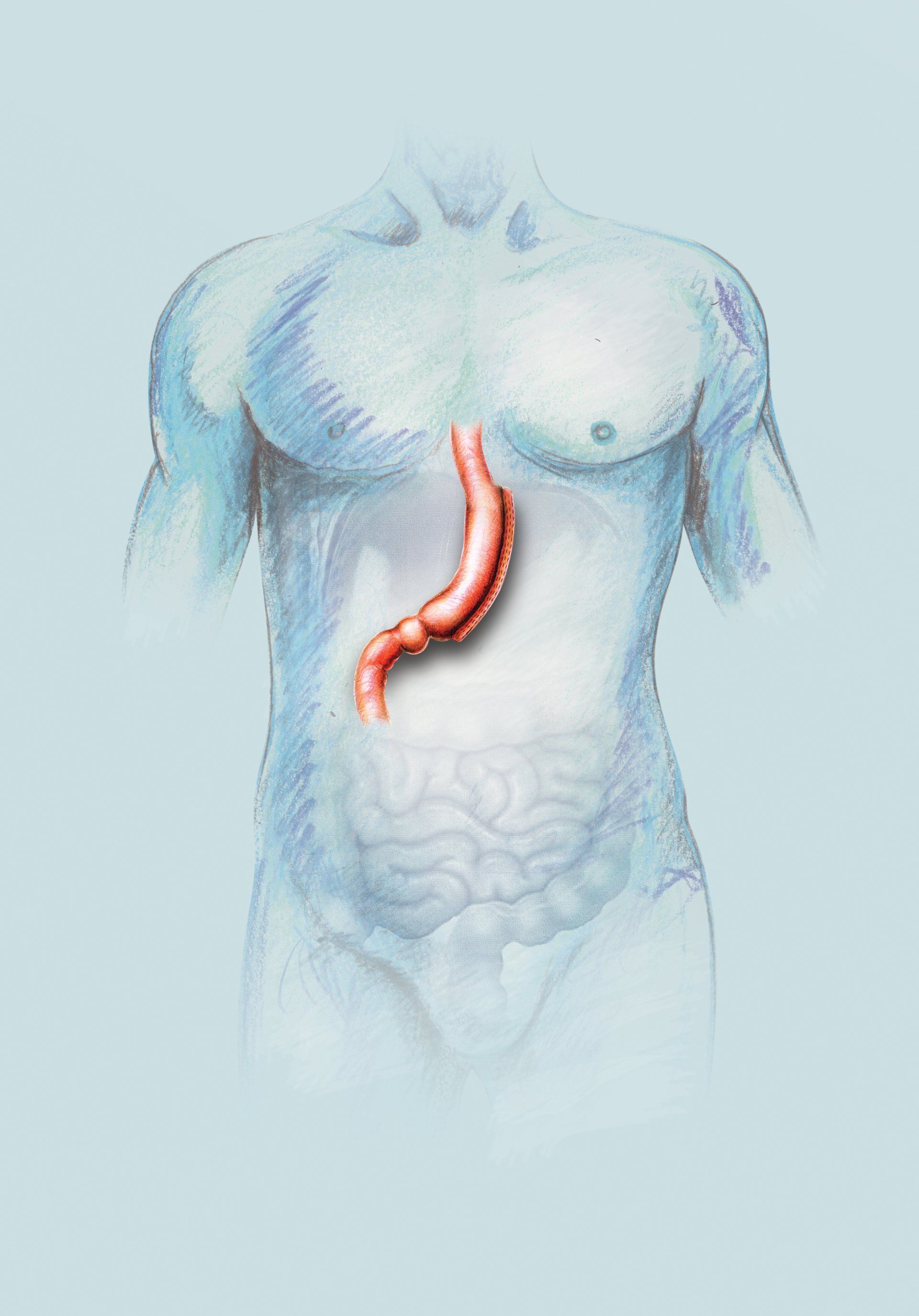 Gastric Sleeve image