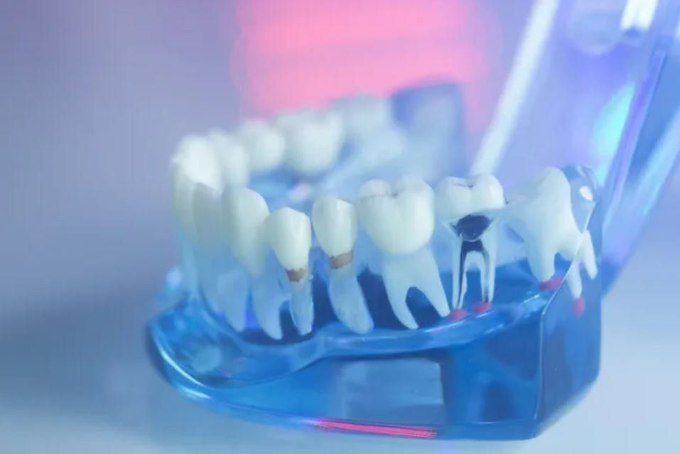 root canal sculpture