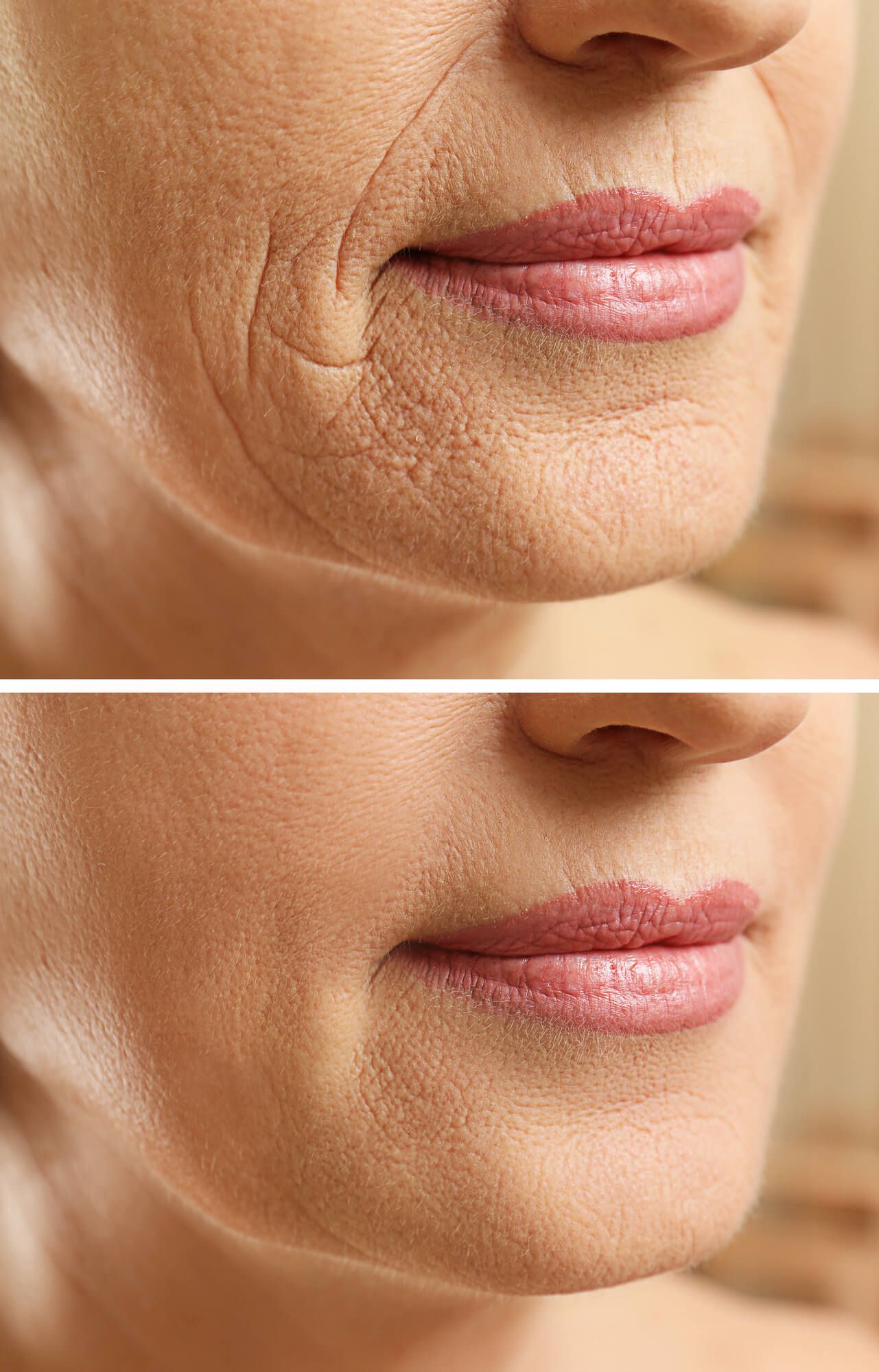 microneedling frau vorher nachher mund falten poren anti age