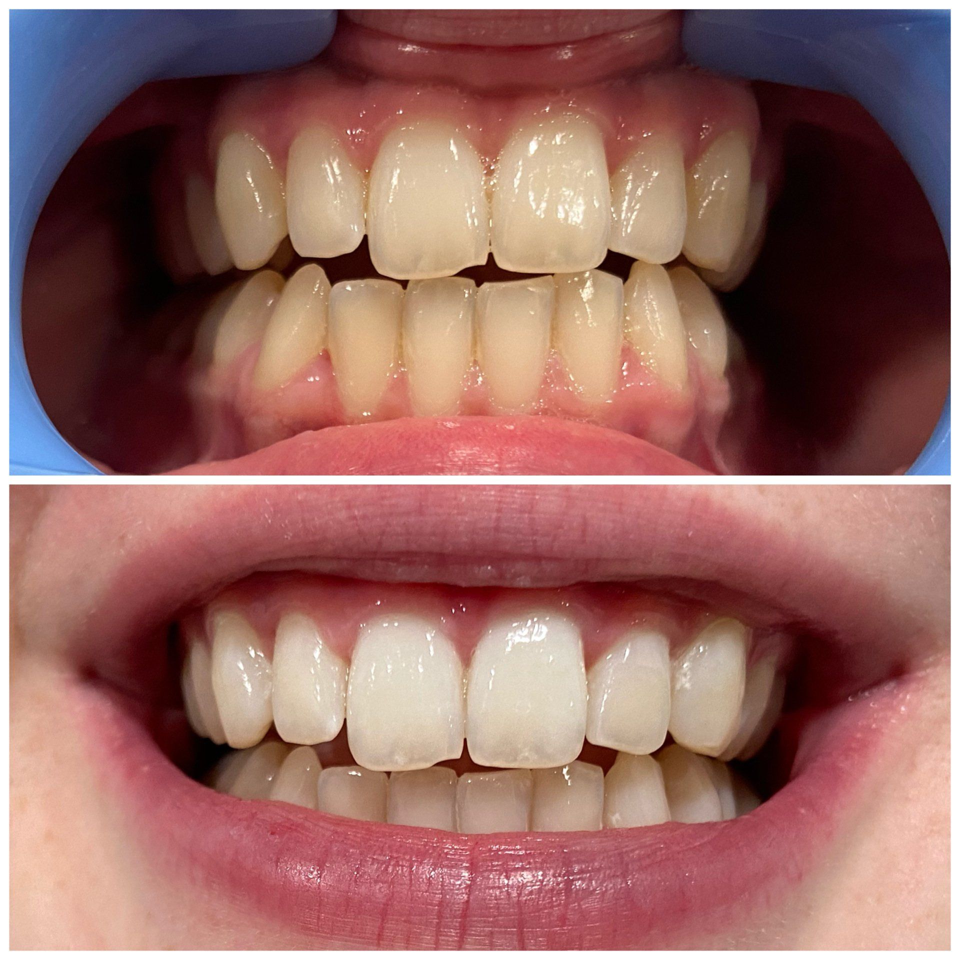 Cosmetic Laser Teeth Whitening Eugene, Oregon Alora