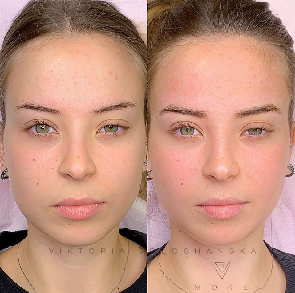 Clienti prima-dopo: tecnica di micropigmentazione sopracciglia