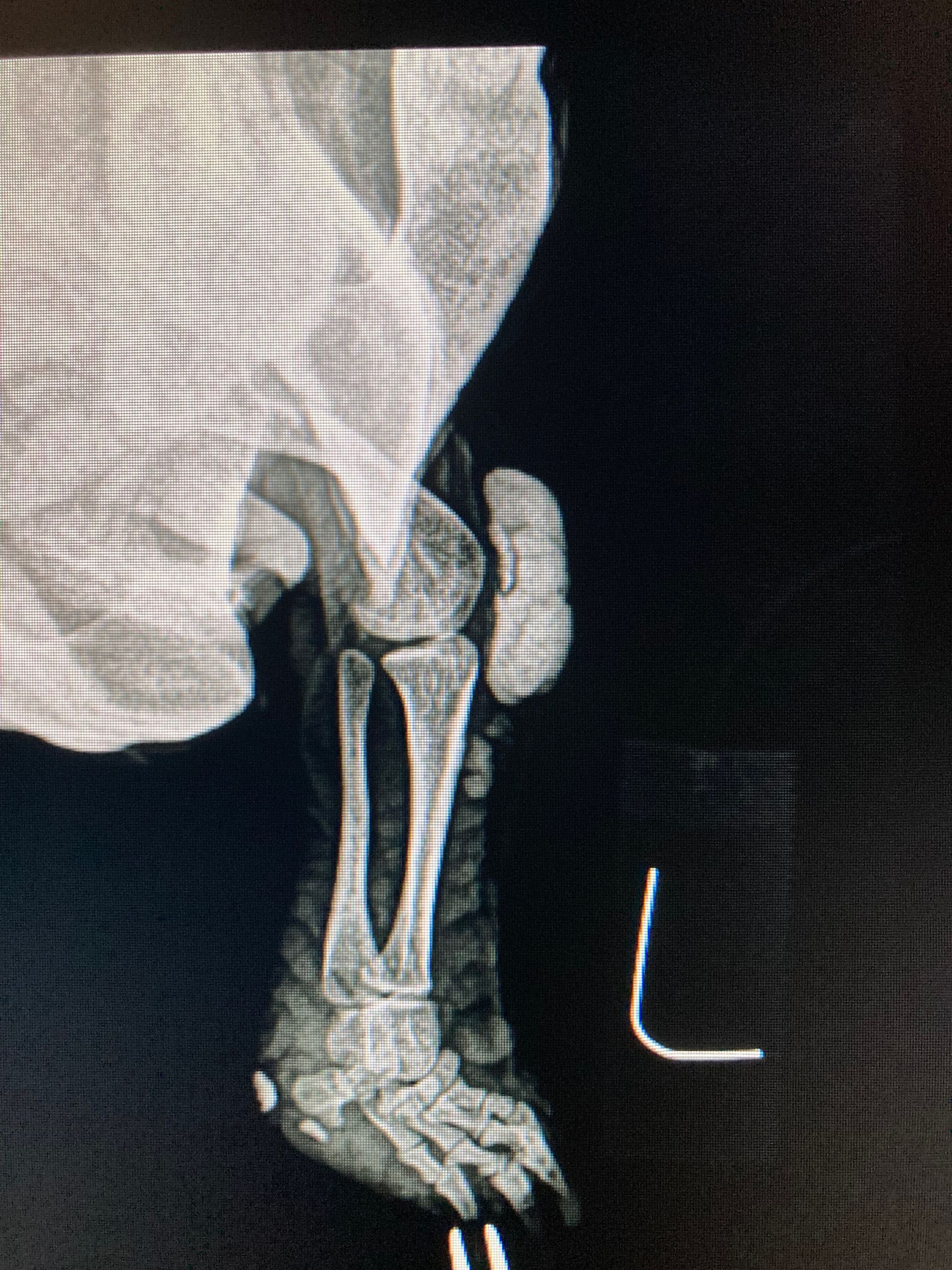 X-Ray Showing Broken Leg And Foot.