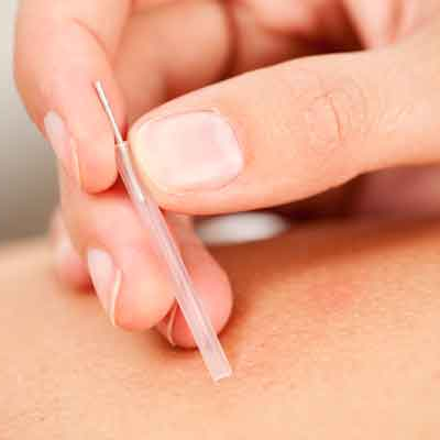 Acupuncture / Dry Needling