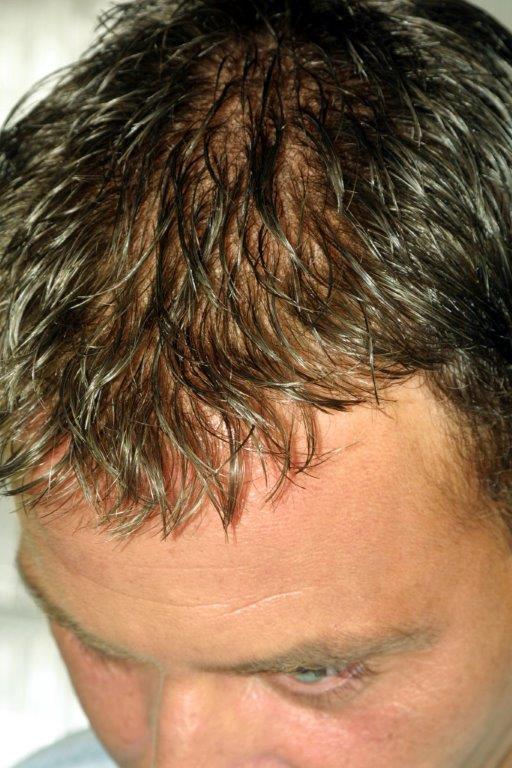 Non Surgical Hair Restoration — Robert in Spokane, WA