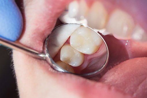 Fillings — Close-up Of A Human Rotten Carious Tooth in Henderson, NC