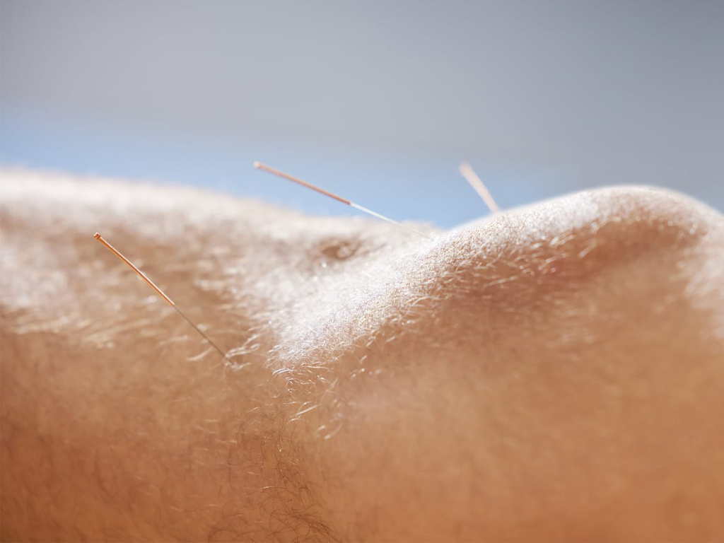 acupuncture in patients Knee Naval Mair Physical Medicine in Wandsworth, London