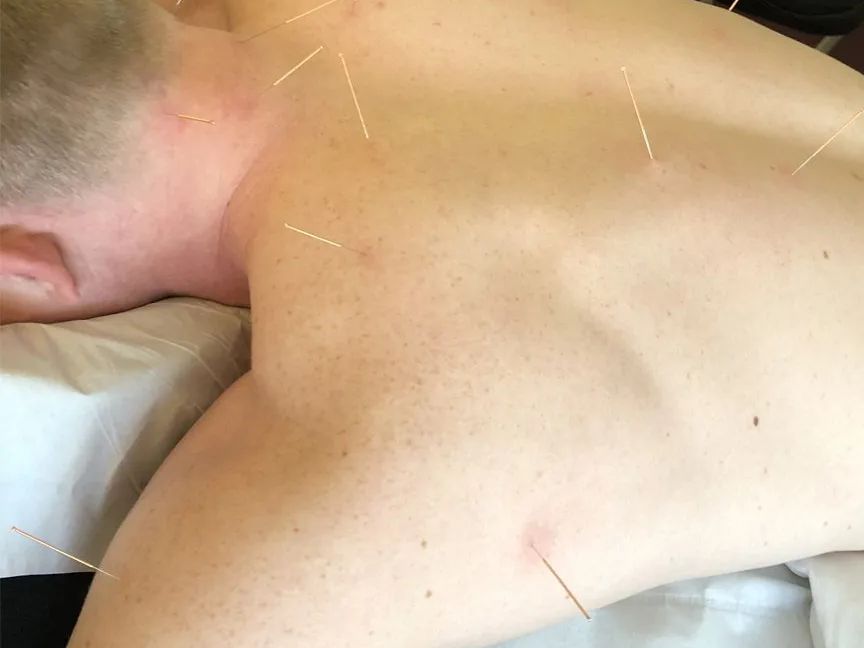 A man is laying on a bed with acupuncture needles on his back.