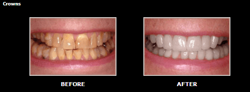 Before and After Image of Crowns