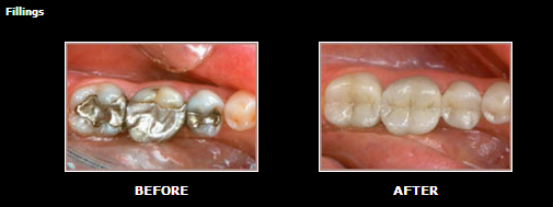 Before and After Image of Fillings