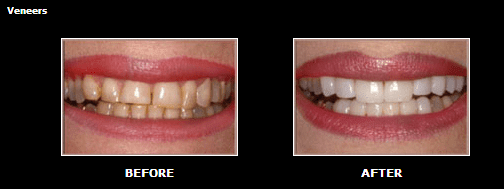 Before and After Image of Veneers