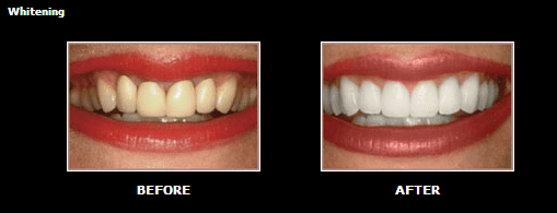Before and After Image of Teeth Whitening