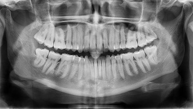 radiografia dentale