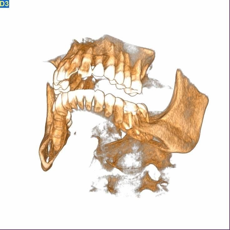 radiografia della bocca