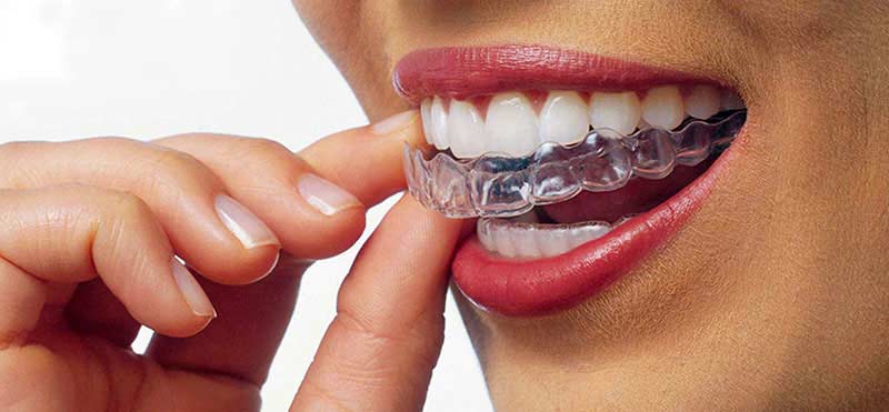 apparecchio dentale