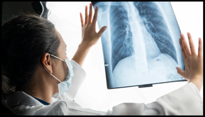 Medical professional analysing a lung X-ray, illustrating the potential respiratory health risks linked to silica dust exposure