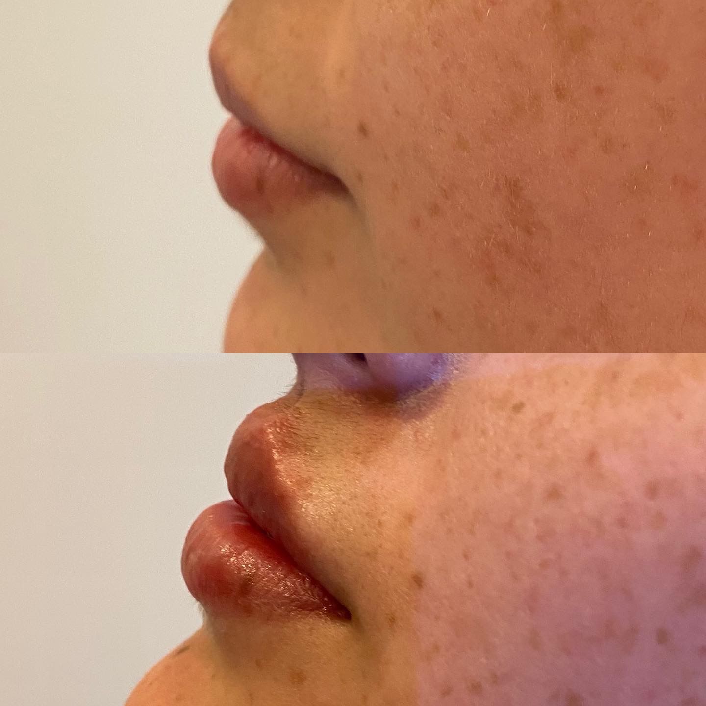 Dermal Filler Before & After Results image