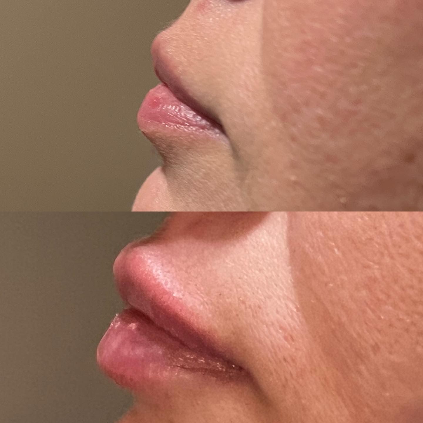 Dermal Filler Before & After Results image