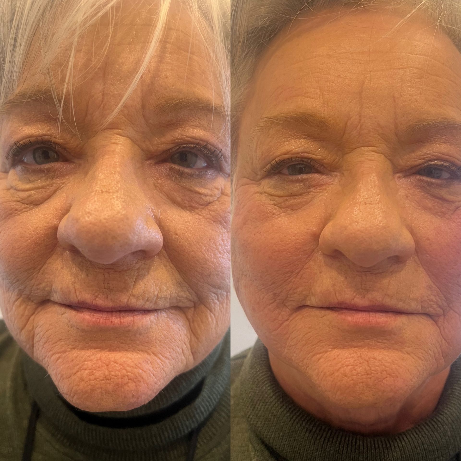PDO Thread Lift Treatment Before & After Results Image