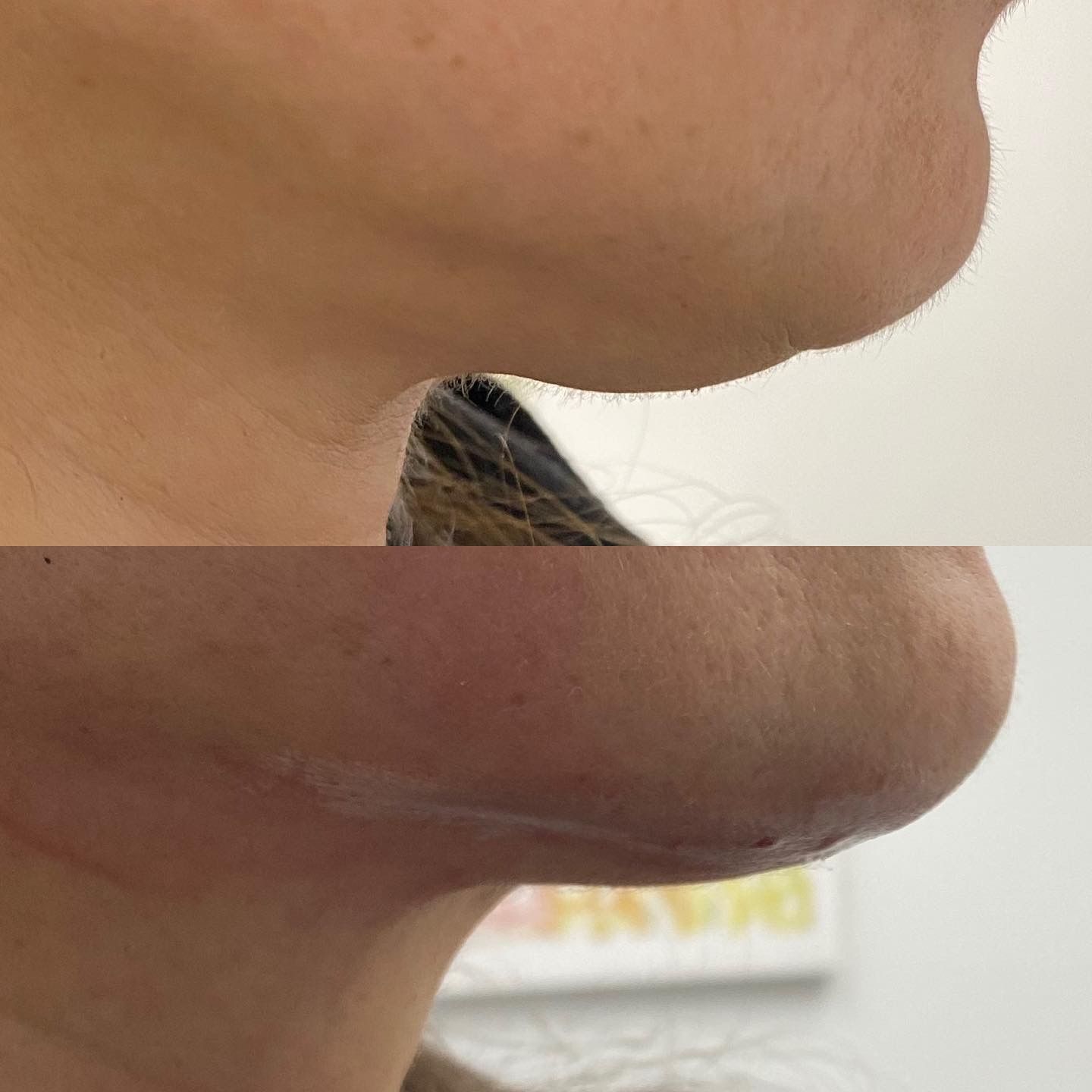 PDO Thread Lift Treatment Before & After Results Image