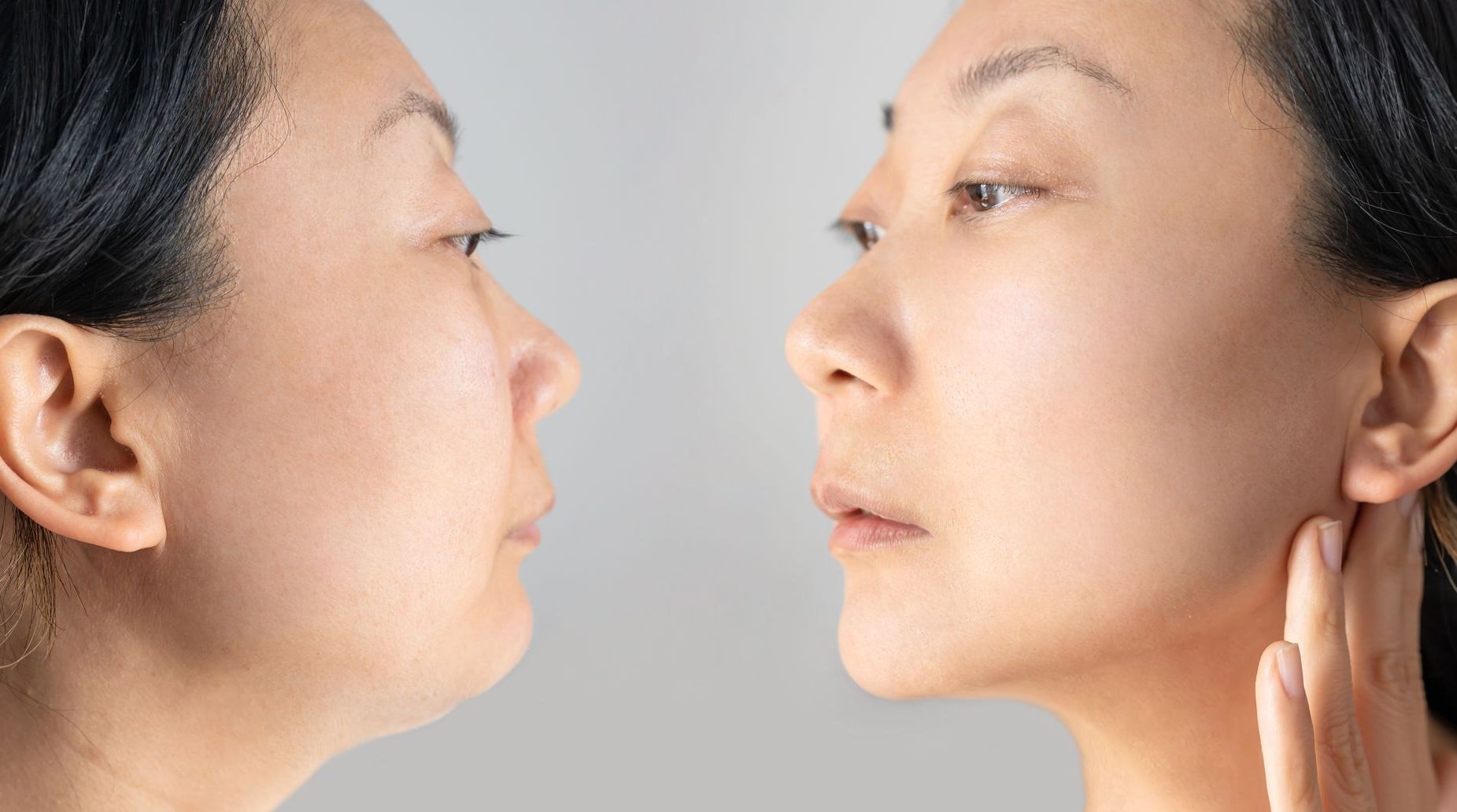 before and after chin fat treatment